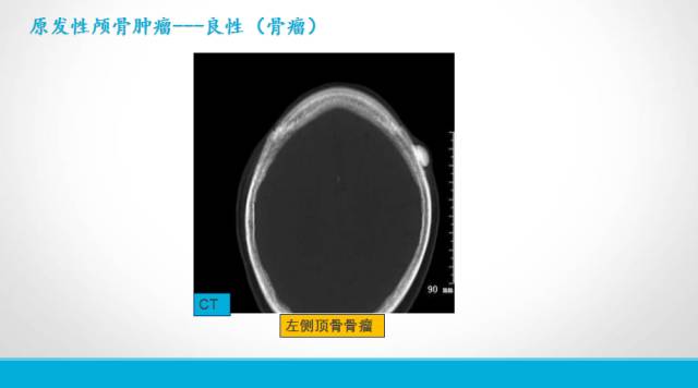 【PPT】颅骨肿瘤及肿瘤性病变影像学详解