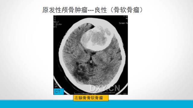 【PPT】颅骨肿瘤及肿瘤性病变影像学详解