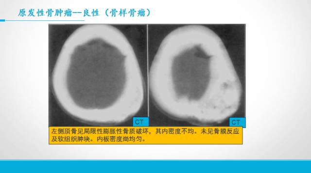 【PPT】颅骨肿瘤及肿瘤性病变影像学详解