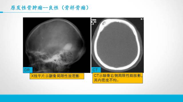 【PPT】颅骨肿瘤及肿瘤性病变影像学详解