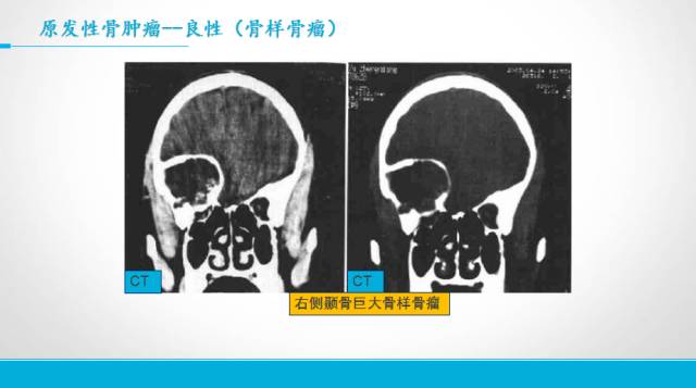 【PPT】颅骨肿瘤及肿瘤性病变影像学详解