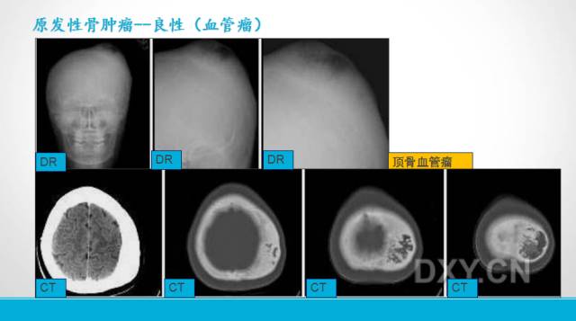 【PPT】颅骨肿瘤及肿瘤性病变影像学详解