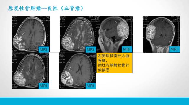 【PPT】颅骨肿瘤及肿瘤性病变影像学详解