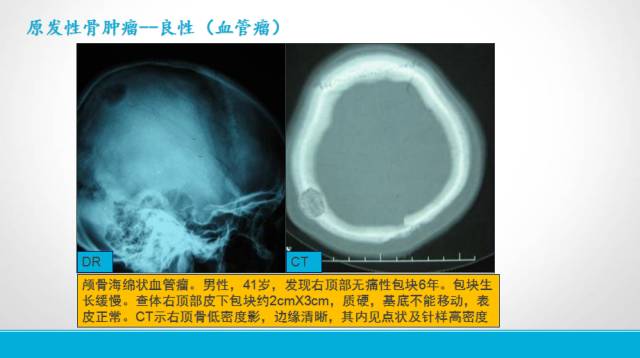 【PPT】颅骨肿瘤及肿瘤性病变影像学详解