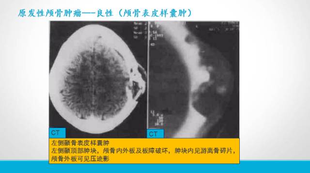 【PPT】颅骨肿瘤及肿瘤性病变影像学详解