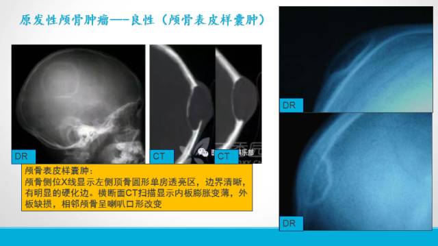 【PPT】颅骨肿瘤及肿瘤性病变影像学详解