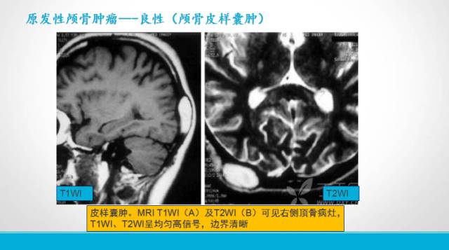 【PPT】颅骨肿瘤及肿瘤性病变影像学详解