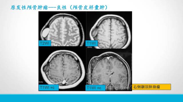 【PPT】颅骨肿瘤及肿瘤性病变影像学详解
