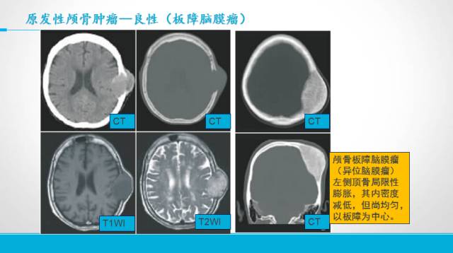 【PPT】颅骨肿瘤及肿瘤性病变影像学详解
