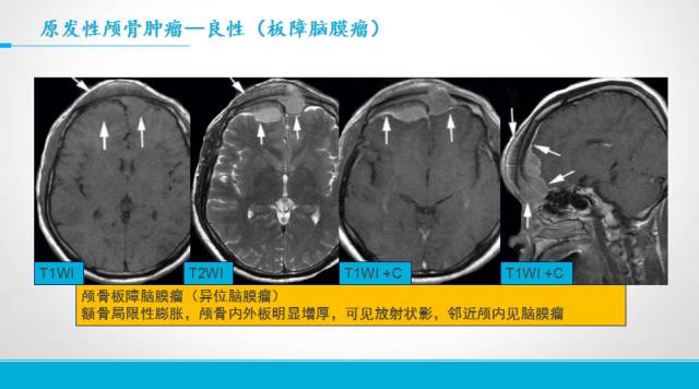 【PPT】颅骨肿瘤及肿瘤性病变影像学详解