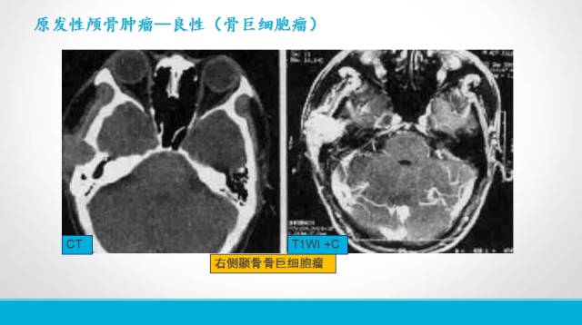 【PPT】颅骨肿瘤及肿瘤性病变影像学详解