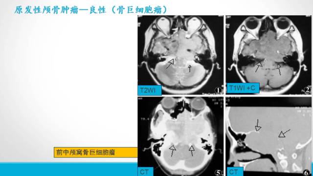 【PPT】颅骨肿瘤及肿瘤性病变影像学详解