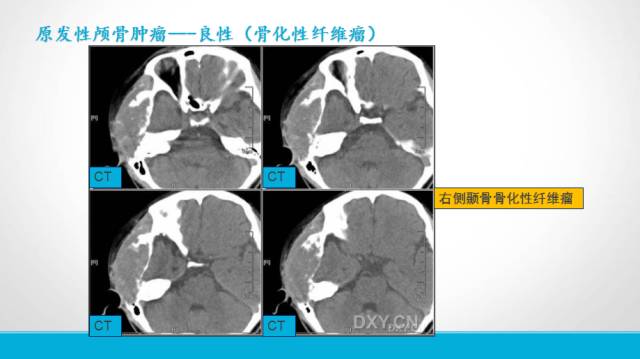 【PPT】颅骨肿瘤及肿瘤性病变影像学详解