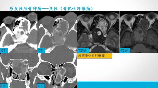 【PPT】颅骨肿瘤及肿瘤性病变影像学详解