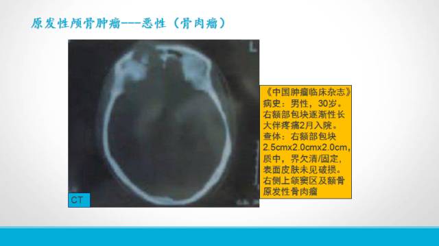 【PPT】颅骨肿瘤及肿瘤性病变影像学详解