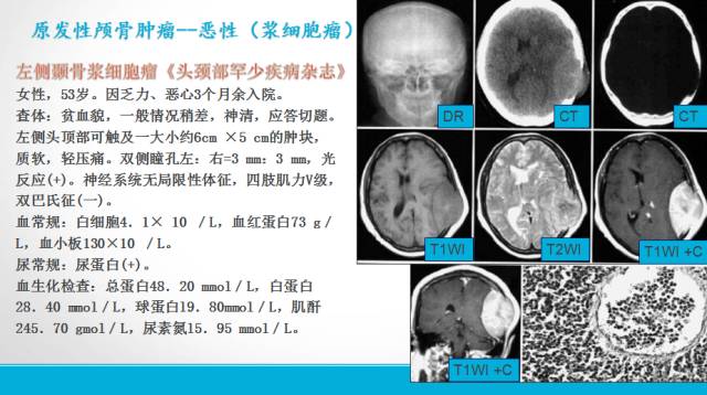 【PPT】颅骨肿瘤及肿瘤性病变影像学详解
