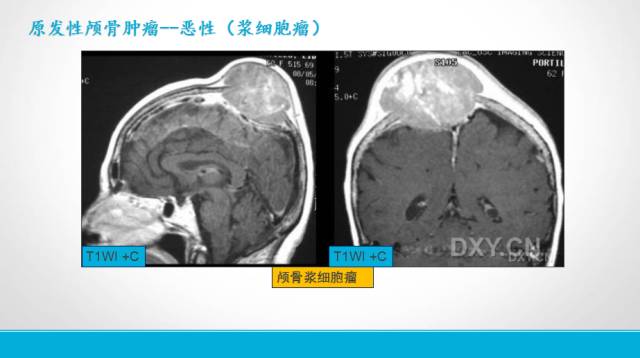 【PPT】颅骨肿瘤及肿瘤性病变影像学详解
