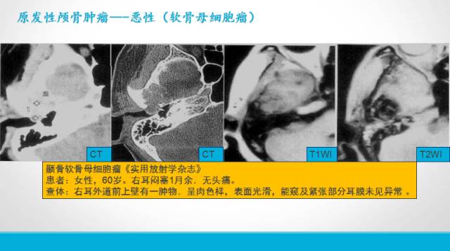 【PPT】颅骨肿瘤及肿瘤性病变影像学详解