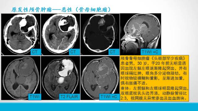 【PPT】颅骨肿瘤及肿瘤性病变影像学详解
