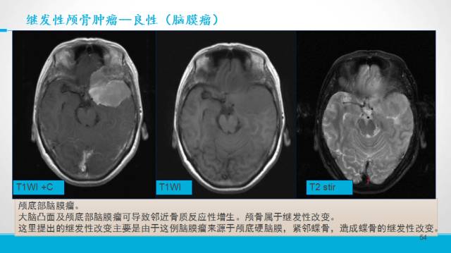【PPT】颅骨肿瘤及肿瘤性病变影像学详解