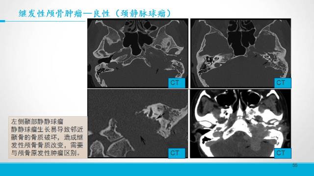 【PPT】颅骨肿瘤及肿瘤性病变影像学详解