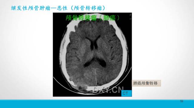 【PPT】颅骨肿瘤及肿瘤性病变影像学详解
