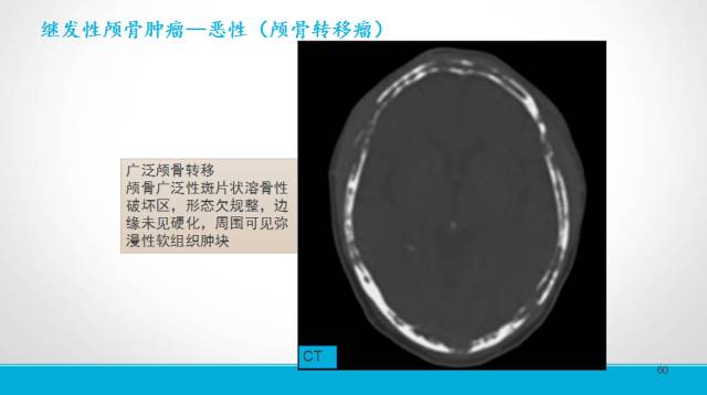 【PPT】颅骨肿瘤及肿瘤性病变影像学详解