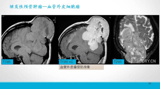 【PPT】颅骨肿瘤及肿瘤性病变影像学详解