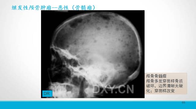 【PPT】颅骨肿瘤及肿瘤性病变影像学详解