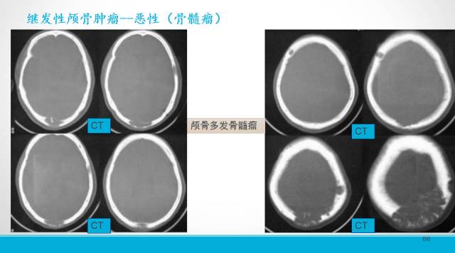 【PPT】颅骨肿瘤及肿瘤性病变影像学详解