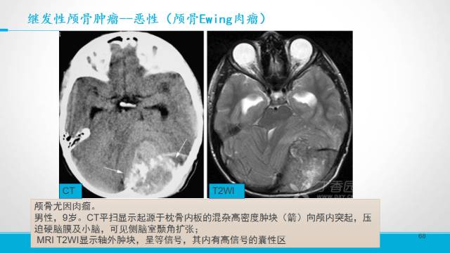 【PPT】颅骨肿瘤及肿瘤性病变影像学详解