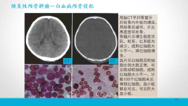 【PPT】颅骨肿瘤及肿瘤性病变影像学详解