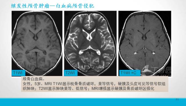 【PPT】颅骨肿瘤及肿瘤性病变影像学详解