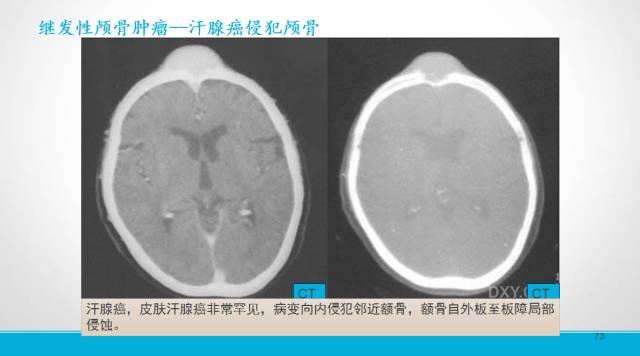 【PPT】颅骨肿瘤及肿瘤性病变影像学详解