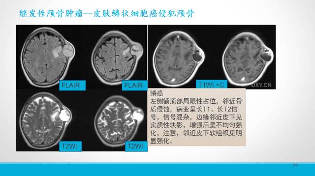 【PPT】颅骨肿瘤及肿瘤性病变影像学详解