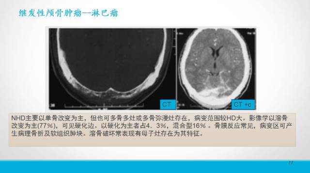 【PPT】颅骨肿瘤及肿瘤性病变影像学详解