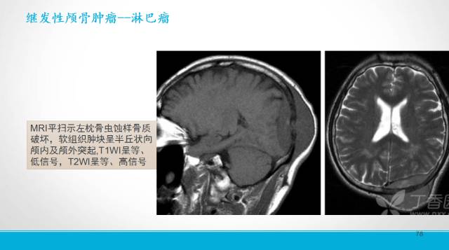 【PPT】颅骨肿瘤及肿瘤性病变影像学详解