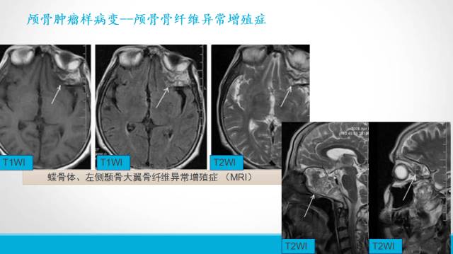 【PPT】颅骨肿瘤及肿瘤性病变影像学详解