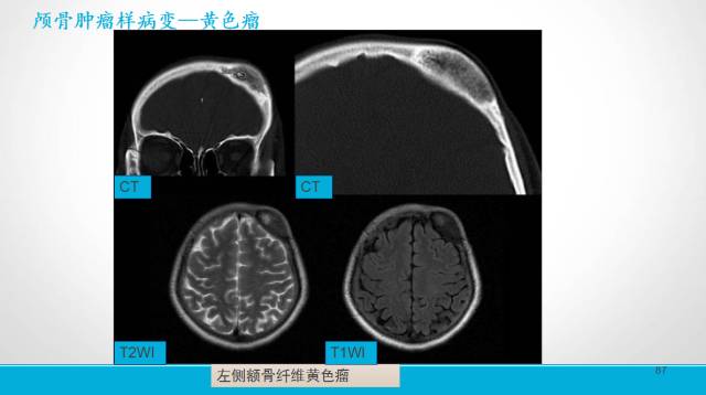 【PPT】颅骨肿瘤及肿瘤性病变影像学详解