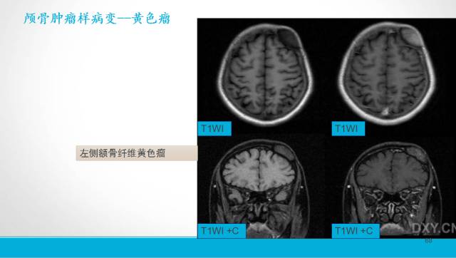 【PPT】颅骨肿瘤及肿瘤性病变影像学详解