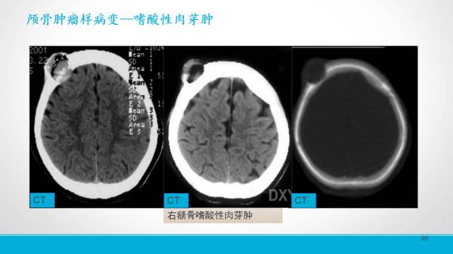 【PPT】颅骨肿瘤及肿瘤性病变影像学详解