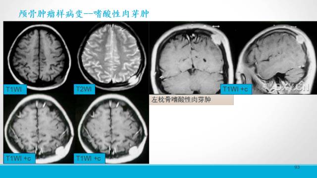 【PPT】颅骨肿瘤及肿瘤性病变影像学详解