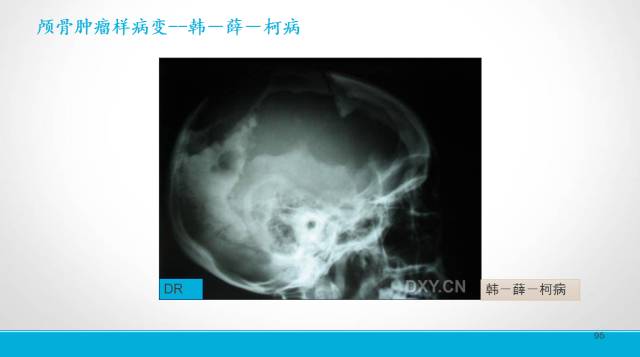 【PPT】颅骨肿瘤及肿瘤性病变影像学详解