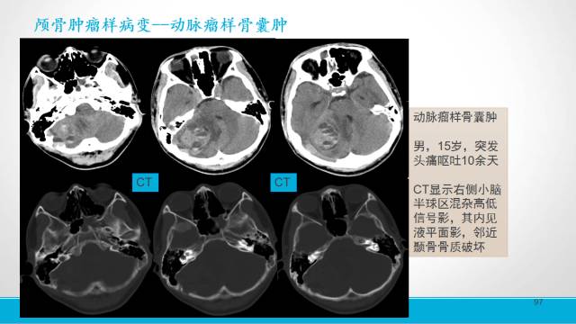 【PPT】颅骨肿瘤及肿瘤性病变影像学详解