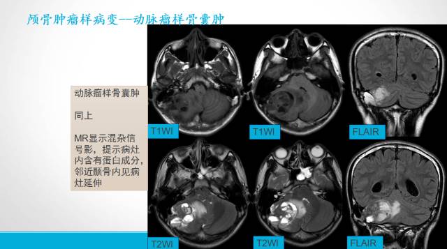 【PPT】颅骨肿瘤及肿瘤性病变影像学详解