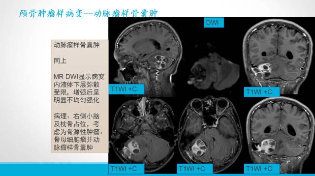 【PPT】颅骨肿瘤及肿瘤性病变影像学详解