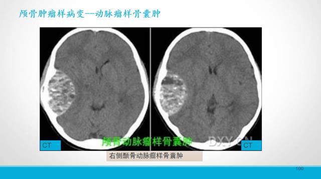 【PPT】颅骨肿瘤及肿瘤性病变影像学详解