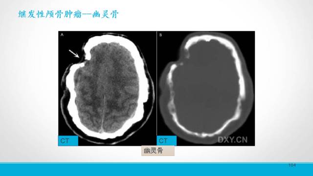 【PPT】颅骨肿瘤及肿瘤性病变影像学详解