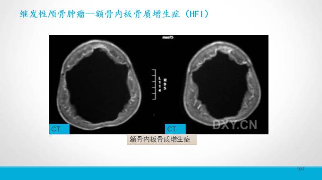 【PPT】颅骨肿瘤及肿瘤性病变影像学详解