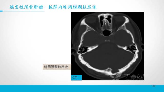 【PPT】颅骨肿瘤及肿瘤性病变影像学详解
